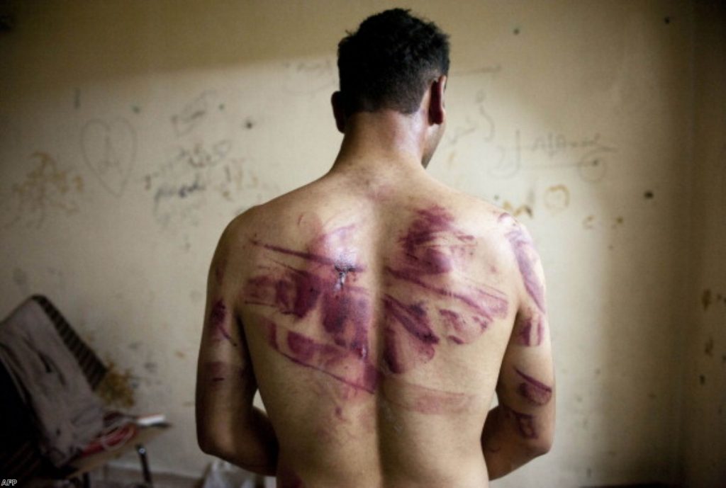 A Syrian man shows marks of torture on his back, after he was released from regime forces